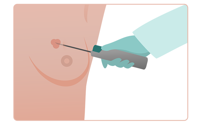 نمونه برداری سوزنی یا core needle نمونه برداری سوزنی یا core needle
