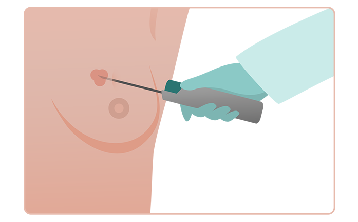 نمونه برداری سوزنی یا core needle